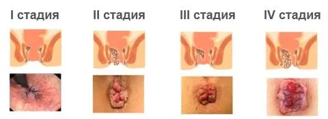 Стадії геморою лікування