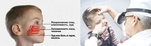 хронічний риніт симптоми у дітей