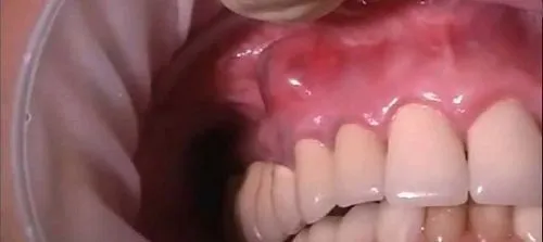 як лікувати свищ ясна