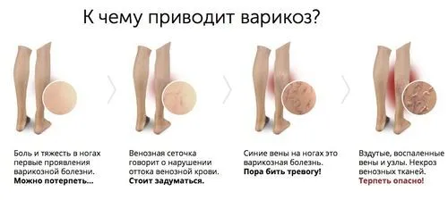 як лікувати варикоз ніг у жінок