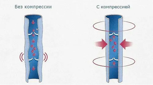 як лікувати варикоз у жінок
