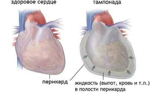 як лікувати забій або перелом ребра