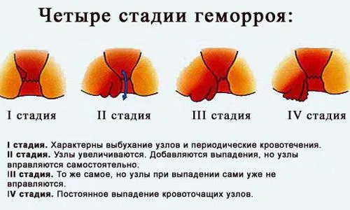 як лікувати геморой ромашкою