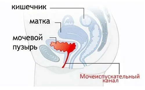 якщо вилікувати уреаплазму цистит пройде