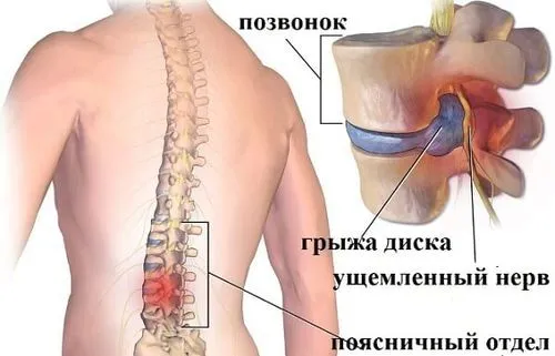 як лікувати остеохондроз 3 ступеня