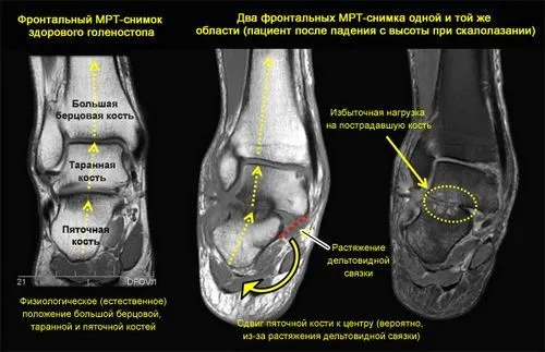 як лікувати розтягнення голеностопа