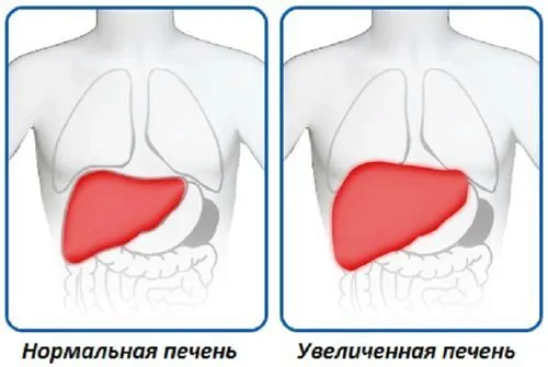 Збільшена печінка у дитини ніж лікувати печінку у дитини