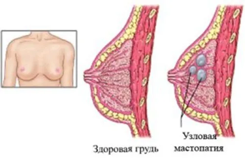 як вилікувати вузлову мастопатію
