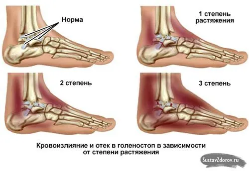 як лікувати розтягнення голеностопа