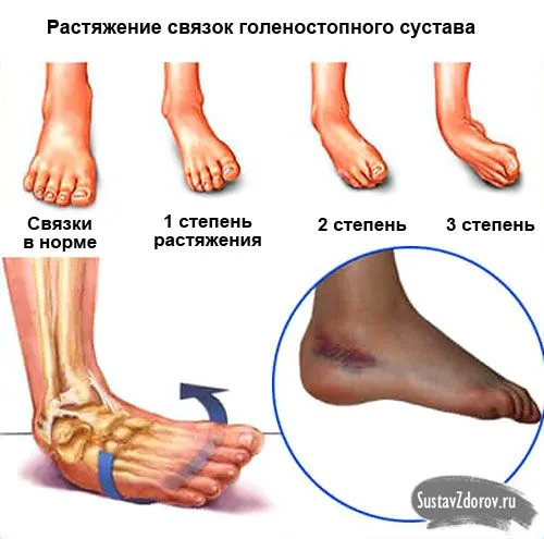 як лікувати розтягнення голеностопа