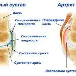 як лікувати суглоби будинку