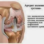 як лікувати суглоби будинку