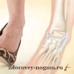 ніж лікувати вивих ноги