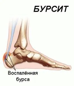 як лікувати бурсит на п'яті