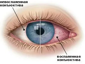 як лікувати очну алергію