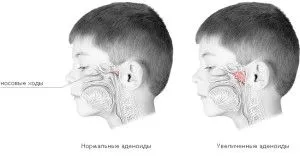 як лікувати гнійні аденоїди