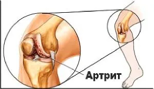 як лікувати суглоби будинку