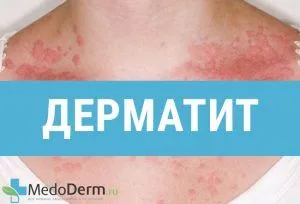 як лікувати атопічний дерматит у немовляти