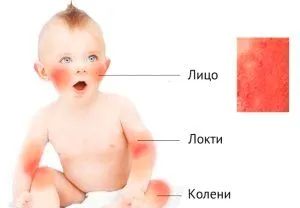 як лікувати атопічний дерматит у немовляти