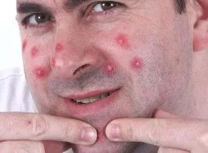 абсцедирующий фурункул симптоми що потрібно знати лікування