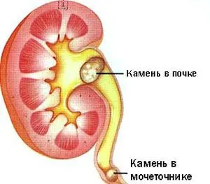 як лікувати нирки якщо є камені