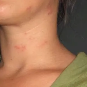 як лікувати алергію на яйця