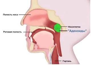 Аденоїди у дітей як лікувати аденоїди і мигдалини