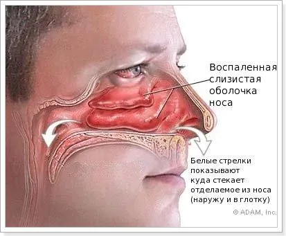 хронічний нежить причини