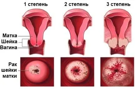 1 Стадія раку шийки матки рак шийка матка стадія 0 1 рання діагностика лікування прогноз скільки живуть