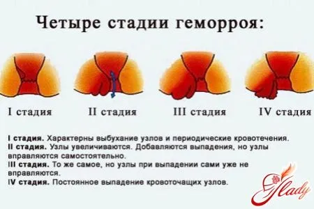 Болі при геморої у жінок як вилікувати геморой без болю