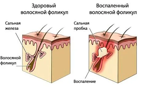 жирна себорея