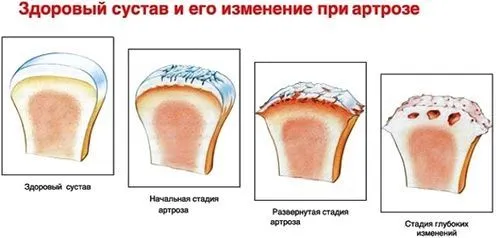 лікувати артроз плеча