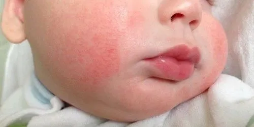 як лікувати алергічний діатез