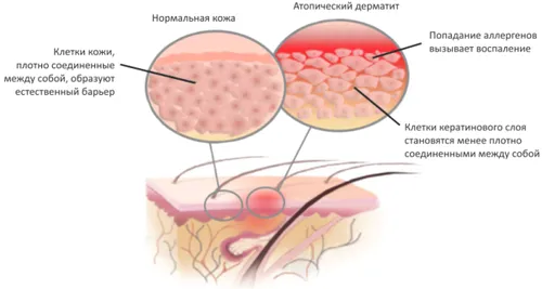 як лікувати алергію у дітей до року