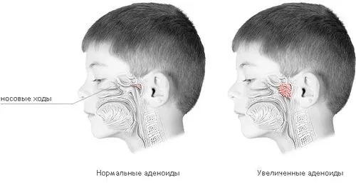 як лікувати аденоїди інгалятором