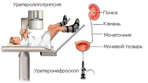 як лікувати нирки якщо є камені