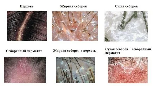жирна себорея