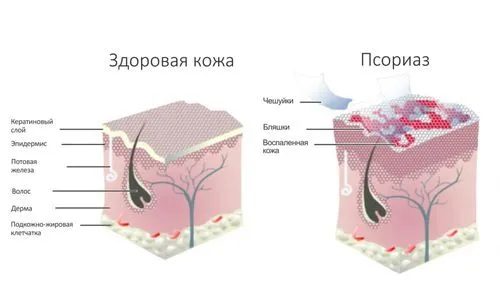 як лікувати хворобу псоріаз