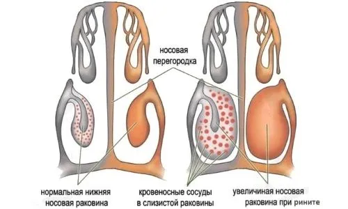 Алергічний риніт у дитини: причини, симптоми і лікування нежиті як лікувати алергічну закладеність носа