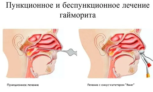 Хронічний гайморит: що це, причини, симптоми, лікування в період... хронічний гайморит в стадії загострення