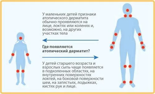 алергічний діатез грудничка причини як виглядає ніж лікувати дитячий мазати мазь крем особі щоках