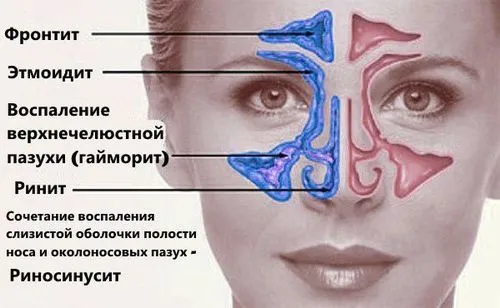 гайморит симптом запалення гайморова пазуха причина ознака метод який дорослий лікувати кашель хвороба чого буває лікування