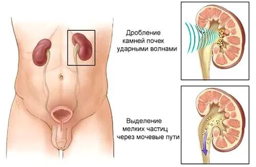 як лікувати нирки якщо є камені