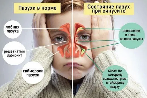 як лікувати риніт у дорослих