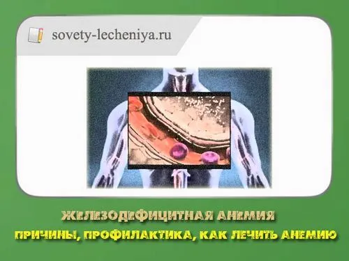 як лікувати анемію