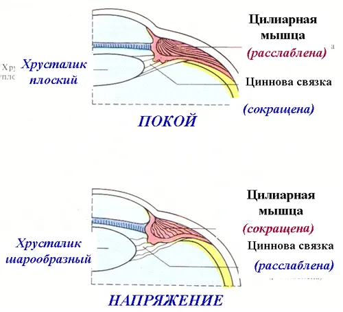 короткозорість
