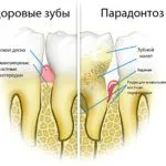лікувати вітрянку в домашніх умовах