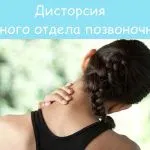 як лікувати радикуліт вправи