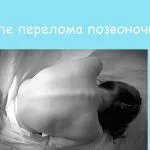 як лікувати радикуліт вправи