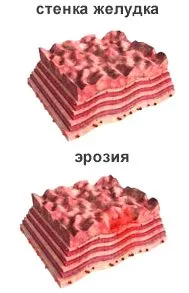 хронічний ерозивний гастрит